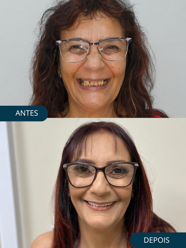 Depois - Prótese Protocolo Paciente 1